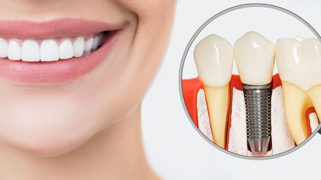dental implants check your eligibilityfreequizconsultation Great